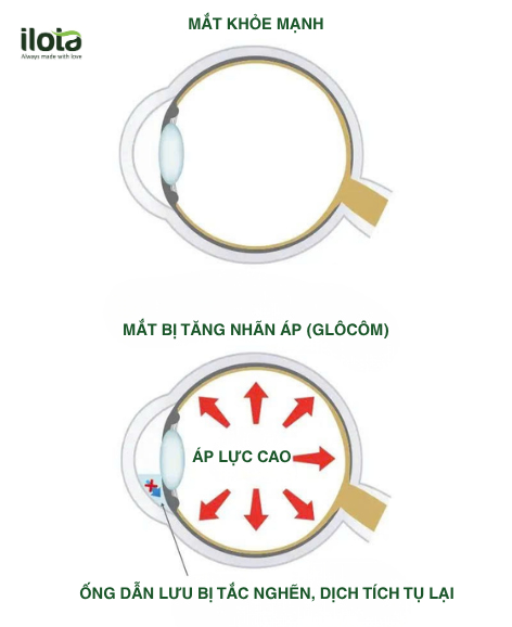ca-phe-hoa-tan-anh-huong-den-mat-ra-sao